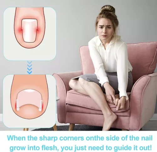 merkloos Ingrown Toenail Correction Kit - 40 Pieces Painless Toenail Smoothing Strips with Toenail Lifter (8785322238837)