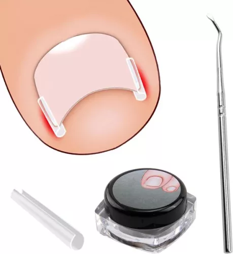 Ingrown Toenail Correction Kit - 40 Pieces Painless Toenail Smoothing Strips with Toenail Lifter