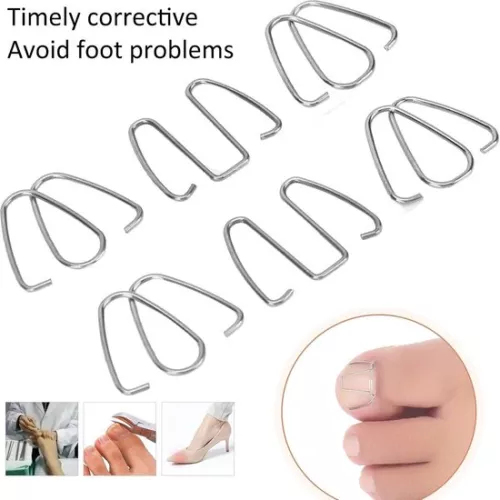 merkloos Ingrown Toenail Corrector Hook - Nail Correction Strips Thread Lifter Tool for Recovery - Women Men Corrector . (8785309165095)
