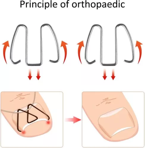 merkloos Ingrown Toenail Corrector Hook - Nail Correction Strips Thread Lifter Tool for Recovery - Women Men Corrector . (8785309165095)