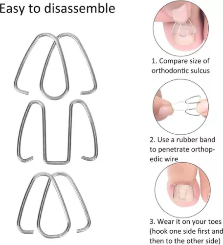 merkloos Ingrown Toenail Corrector Hook - Nail Correction Strips Thread Lifter Tool for Recovery - Women Men Corrector . (8785309165095)